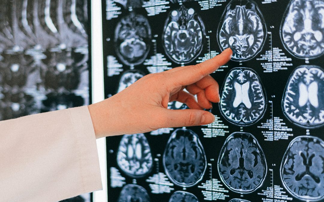 main d'une personne en blouse pointant sur une partie du cerveau montré par une radio.